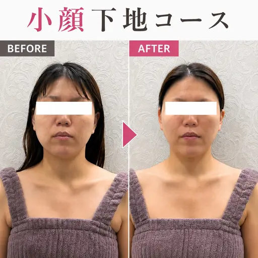 【たるみ/えら張り】改善 口コミご協力いただける方限定¥20,900→¥1,000 高濃度コラーゲン🫧×小顔コース💆
