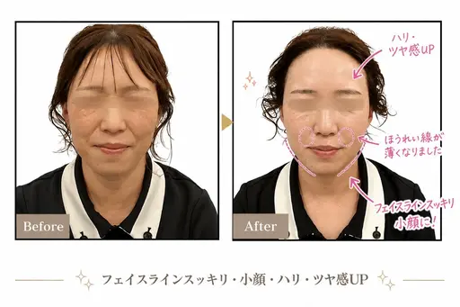 【小顔・たるみケア】✨極上リフトＵＰ✨美顔器フェイシャルエステ