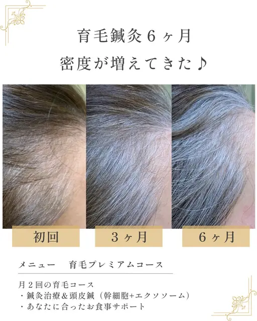 【育毛鍼】で薄毛・抜け毛・産後脱毛を改善♪
