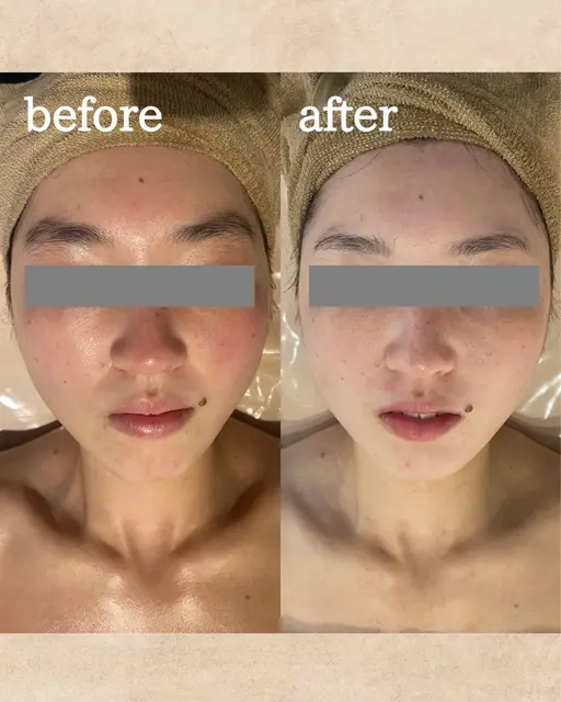 【人気メニュー】白玉小顔矯正🤍美肌ケア付きの小顔ケア💆🏼♀️