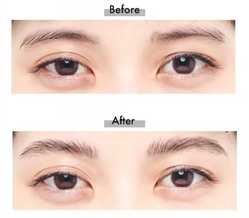 美眉矯正+眉毛wax脱毛