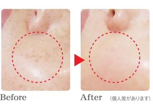 大きなシミや広範囲で当てたい‼️シミ30分当て放題✍+導入美容液のぷるつや仕上げ付き🥝🥝