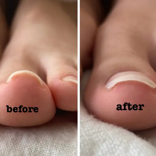 【FOOT】(オフなし)親指巻き爪ケア+ジェルワンカラー