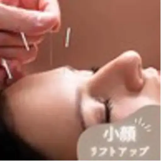 【人気NO.1】小顔矯正♪ 美容鍼(電気パルス付)+幹細胞パック 5500 → ¥2850