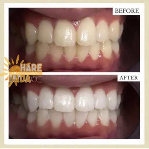 短時間で白さ実感✨🦷30分照射セルフホワイトニング