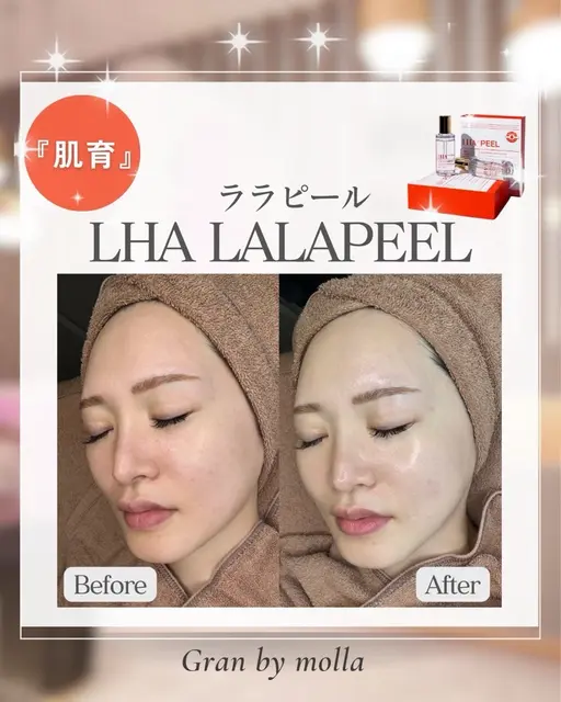 肌改善✨ダウンタイム無し！憧れの水光肌へ🫧🫧韓国美容​〜​ララピール​〜​¥12,800(通常)⇒¥9,800(初回限定)