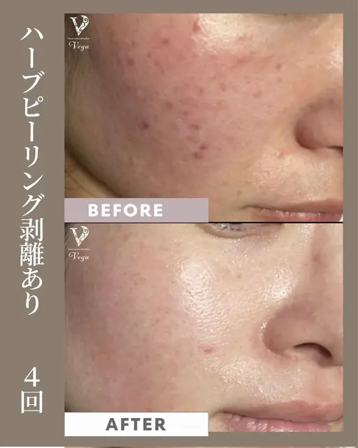 【ニキビ肌専用】ハーブピーリング剥離あり/翌日メイクOK