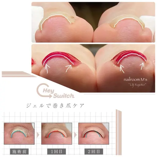 巻き爪ケア/Hey Switchヘイスイッチ/片親指1本
