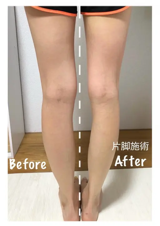 【当店人気No1】下半身痩身🦶【セルライト・むくみ・たるみ・肉割れ】施術直後のむくみ改善・脚の軽さに感動の声多数✨