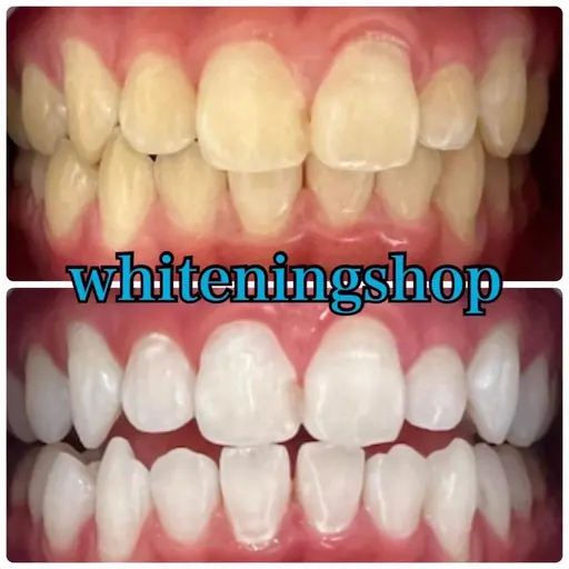 【🌟超お得/効果抜群🌟】初回ホワイトニング40分照射¥9,900→¥3,980