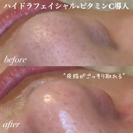 人気No.1🏆【しつこいニキビ・黒ずみ卒業✨】集中毛穴ケアコース👌🏻ハイドラ+ビタミンC導入🍋口コミ価格💭