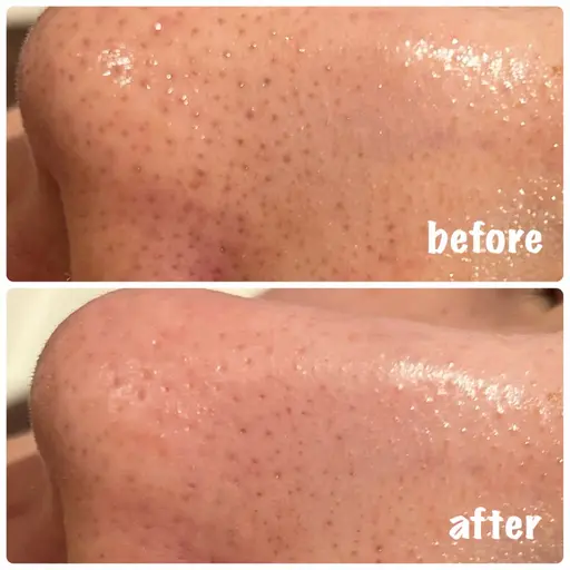 【毛穴詰まりリセット🧼】お肌がうるおう🚿毛穴洗浄×インナーケアカウンセリング付【口コミ価格】