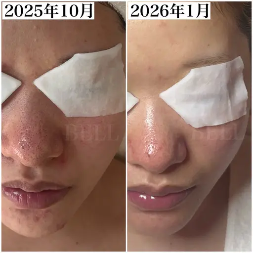 【人気No.1毛穴黒ずみ集中ケア】デコルテ＋ヘッドスパ付 90分 通常料金13,000円