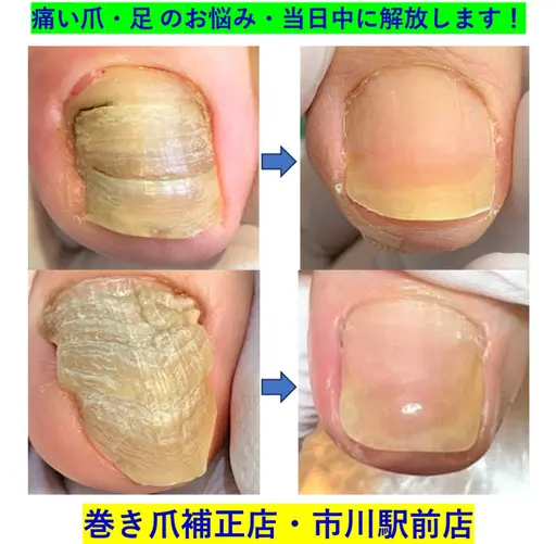 変形爪ケア　1爪(google口コミ投稿特別価格)