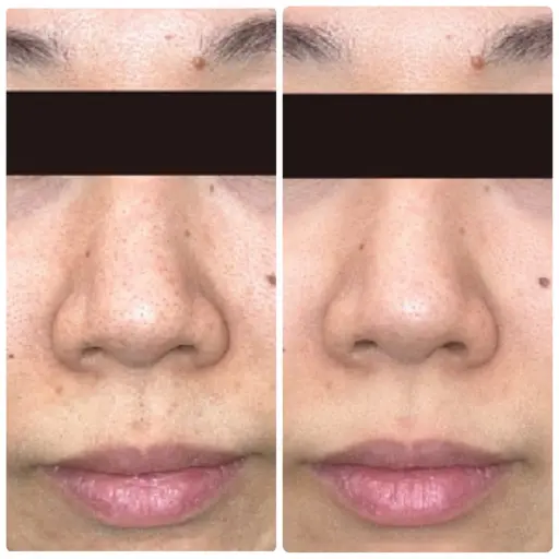 【毛穴開き・黒ずみ集中ケア】毛穴洗浄/選べるパックでつるん肌実感 30分 ¥7700→¥5500