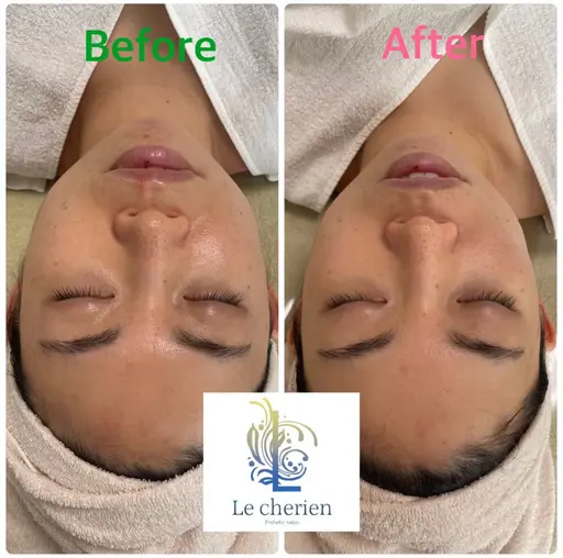 リフトアップコース