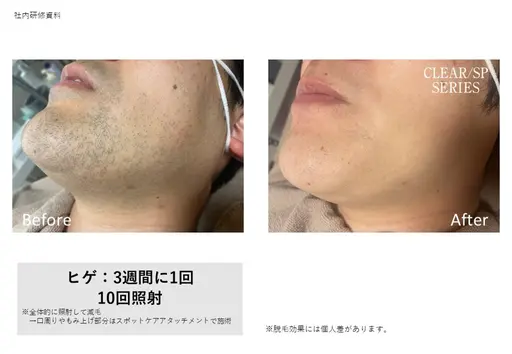 全顔脱毛パック