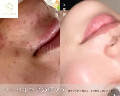 ミニモ限定【先着5名様】最高品質剥けるハーブピーリング×鎮静ケア《顔用》🌿人気No.1