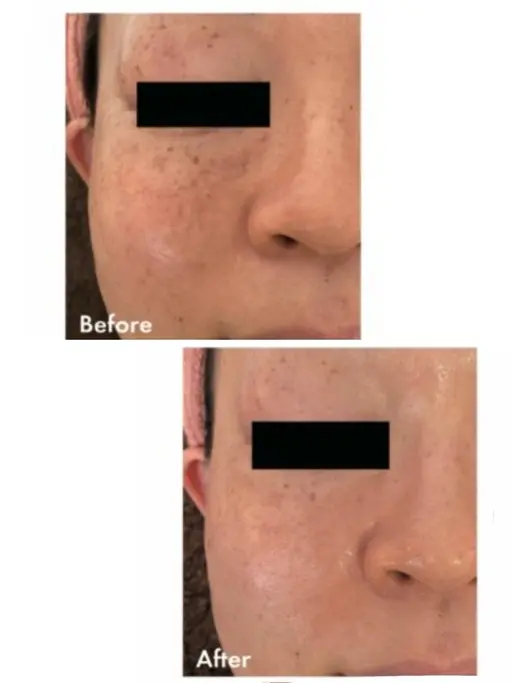 【肌質改善✨】ホワイトスノーピール