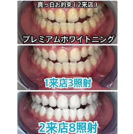 【人気No.1】プレミアムコース❣合計 8回 2 来店（1回10分照射）❣ジェル代別途