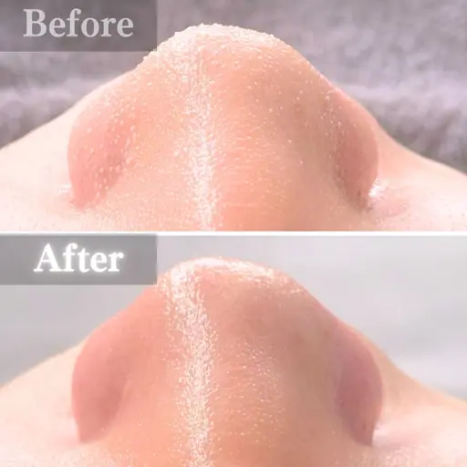 【人気No.1🔥角栓汚れゴッソリ】全顔毛穴洗浄 × 高濃度ビタミンC浸透ケア◎ニキビやいちご鼻でお悩みの方にも