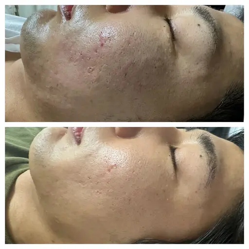 令和の虎で話題の針入りハーブピーリングボディ1箇所（毛穴／テカリ/ニキビ／肌荒れ／乾燥＞