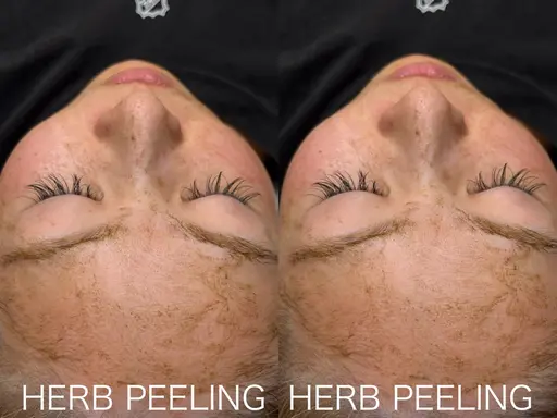 【韓国式ハーブピーリング🇰🇷🌿】1回で剥離！効果絶大🩵🪄 熊本で受けれるのは当店だけ！！