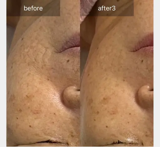 結果重視！純粋レチノールピール🍋