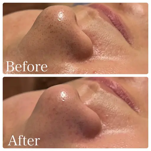 【鼻のみ洗浄コース👃🏽】鼻のしつこい角栓や黒ずみケア/鼻だけ集中して洗浄➕鼻パック❗️