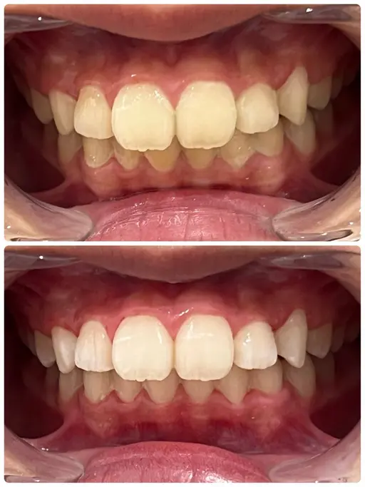 【ご新規】歯のセルフホワイトニング🦷サポートあり！15分2回照射で満足な白さに！