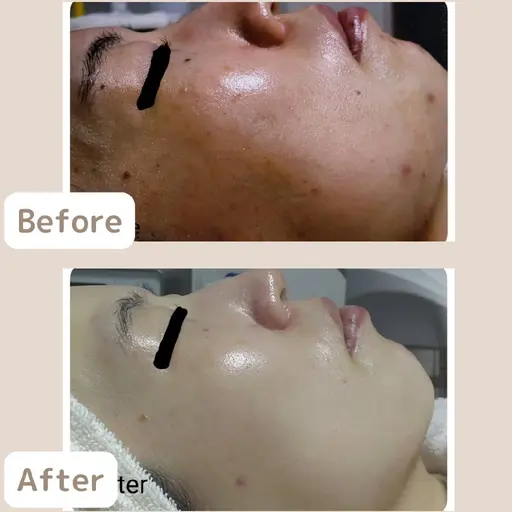 《繰り返すニキビ卒業！》社会人🈹ビタミン導入でニキビのできにくい肌作りコース　2回体験　[大阪城北詰/京橋駅]