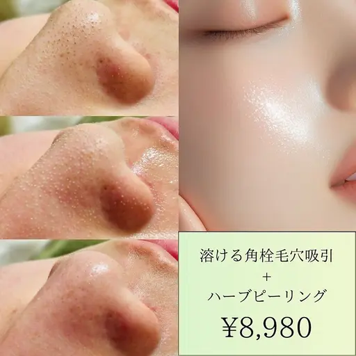 【最強ケア】溶ける角栓毛穴吸引+ハーブピーリング ¥8980→¥7,000