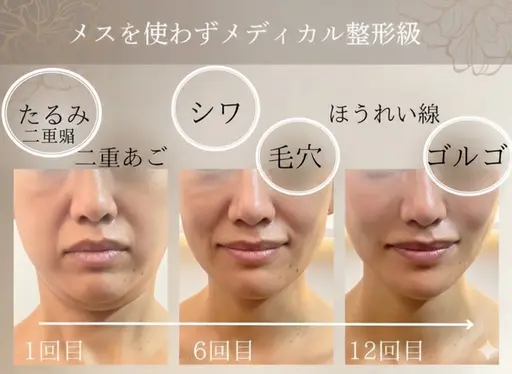 【初めての方/5名限定】韓国最新Vリフト小顔マシン＋７Dコルギ/95分￥16999→8,999円