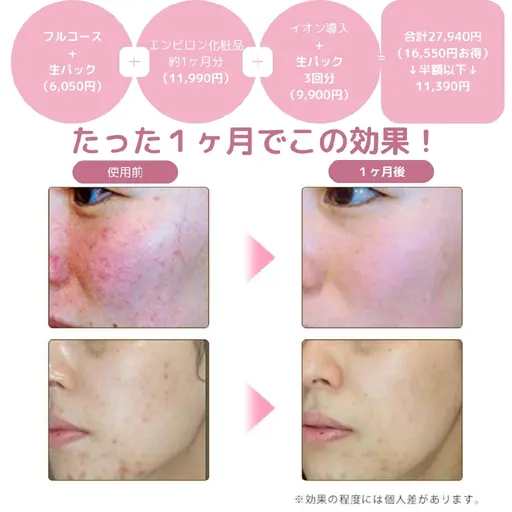 1ヶ月で肌質改善！エステモニター募集