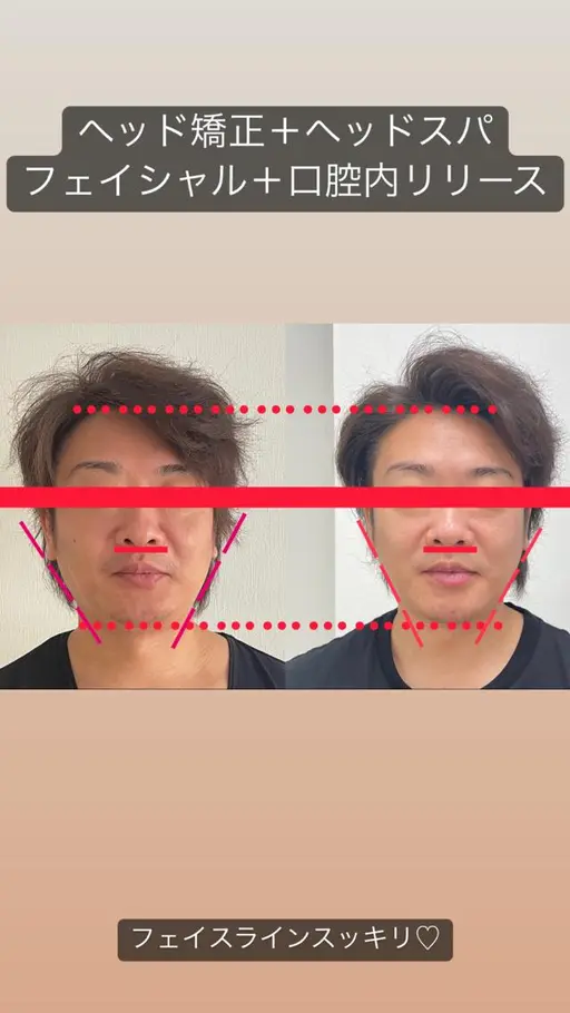 【丸顔,面長、エラ張り】骨格から変える小顔矯正＋ヘッド矯正＋ハイパーナイフ 45分　オプション,デンバリブラシプレゼント