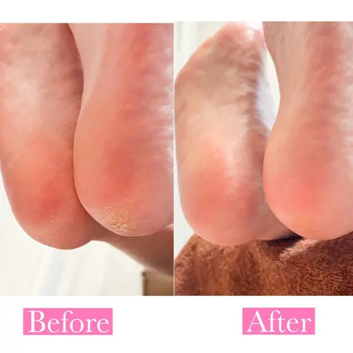 《 フット角質ケア 》 フットバス、角質除去、磨き上げ、保湿でつるつるな足裏に🫧