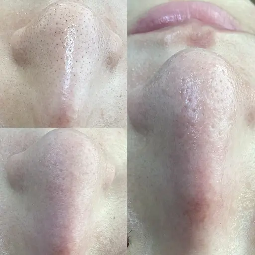 【毛穴洗浄】毛穴レスでSNSで話題沸騰中！韓国式3D毛穴洗浄！ブラックヘッド・いちご鼻解消‼︎