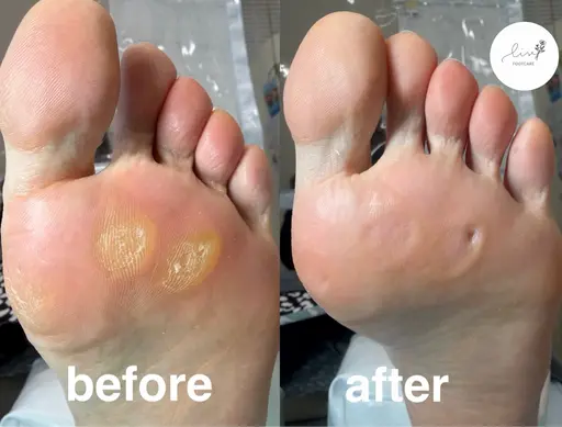 トータル角質ケア 魚の目個数制限なし (魚の目・タコ・かかと足裏全体ケアします)※初めての方にオススメ