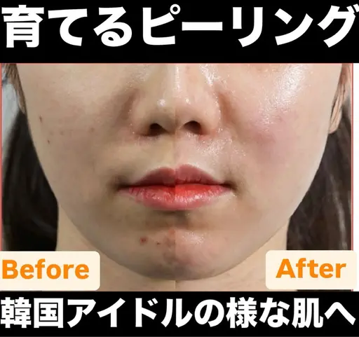 韓国肌管理🇰🇷ララピール【顔＋首】で毛穴レス×ハリ艶UP