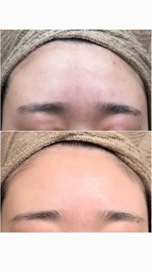 最新プラズマ⚡️フェイシャル