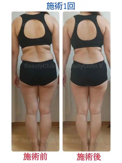 【結果重視】痩身エステ～筋膜リリース～