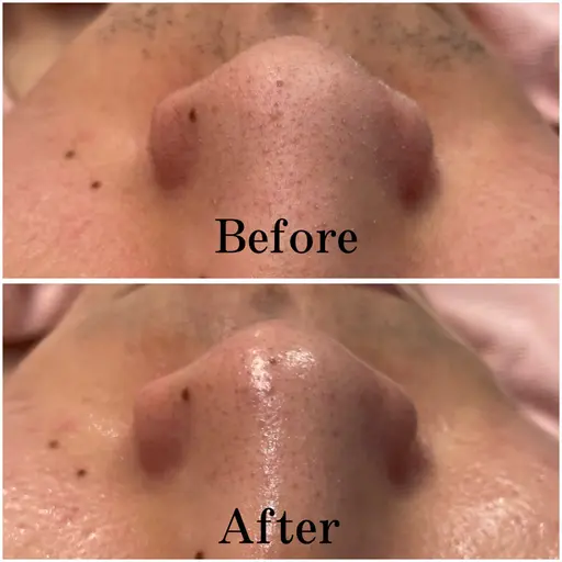 【🌟4/20限定🌟】お顔剃り＋全顔毛穴洗浄＋ハイドロジェリーマスク