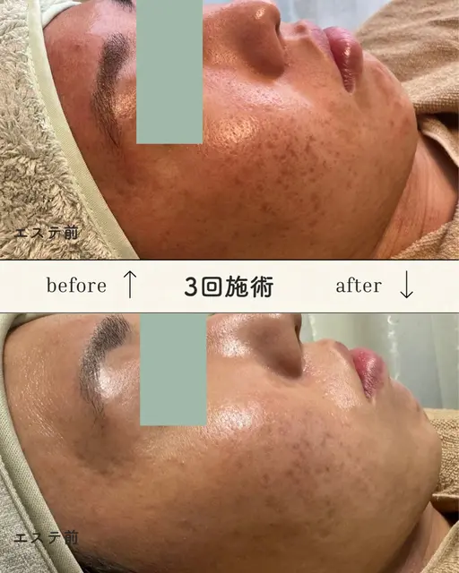 【モニター】ニキビ、ニキビ跡専用エステ