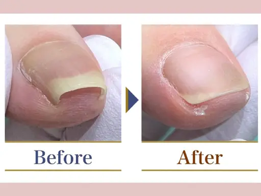 【巻き爪1箇所】痛みがある方！痛みがなくても巻きが強い方！！専用の器具で優しく、効果的な施術をいたします。