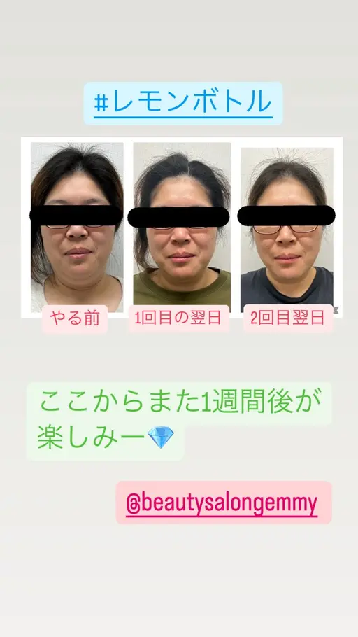 水光肌白玉エステ⭐️小顔韓国美容⭐️エステ版ポテンツァで美容液導入+筋膜リフト!