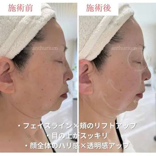 卒業式・入学式前限定🌸写真に残る“ママのためのリフトアップケア”