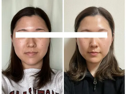 お1人さま1回限り！魔法の小顔矯正【エンドリングフェイシャル】モデルさん募集★ 12000円→4500円