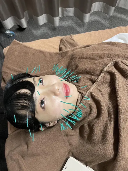 トータルエイジング美容鍼