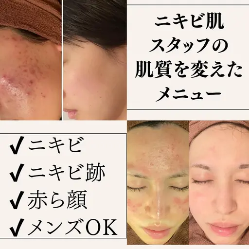 私の激荒れ肌はこれで改善した👀｜1日2組限定の当サロンオリジナル・ニキビ/ニキビ跡ケアコース👼✨