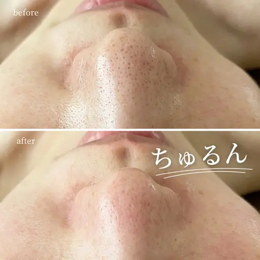【毛穴ちゅるん】美容液でお肌を洗う!ハイドラ毛穴洗浄